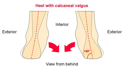 Valgus calcaneen