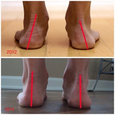 arch-ankle-improvement-1