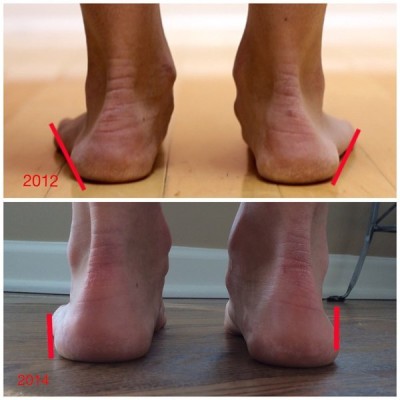 arch-ankle-improvement-3