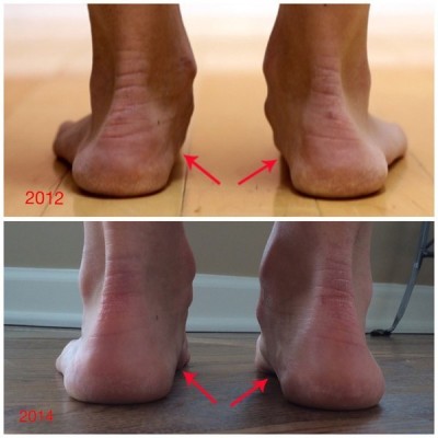 arch-ankle-improvement-4