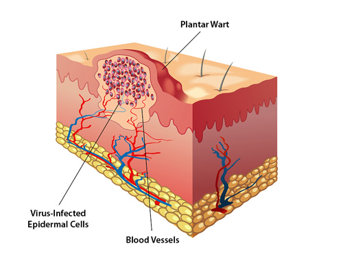 Treatment and Removal of Plantar Warts - Kids' Foot Health diagram showing a cross section of skin with plantar warts on the surface and virus infected epidermal cells below