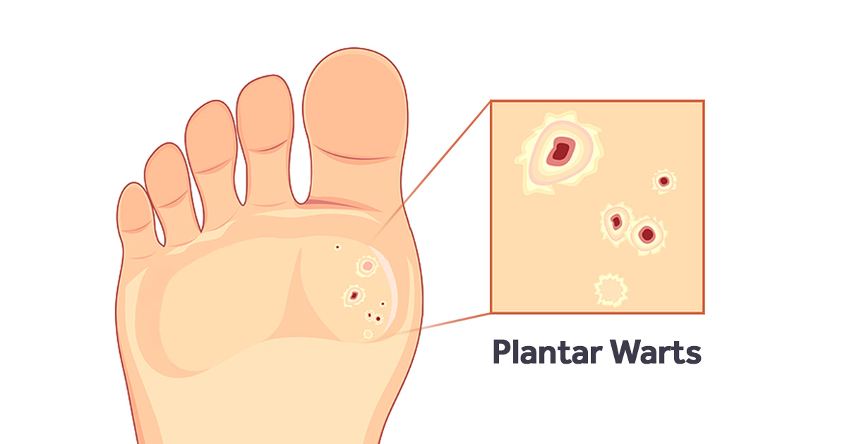 Plantar Wart Self Care: How to Get Rid of Warts on Kids' Feet