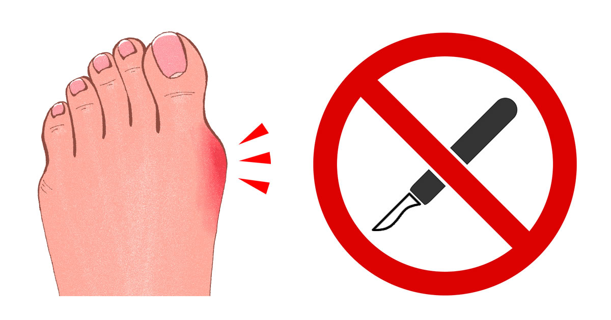 How to Shrink Bunions Naturally: Easier Than You Think