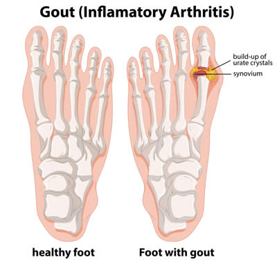 diagram showing a health foot bone structure compared to a foot with gout where there's a build up of urate crystals in the big toe
