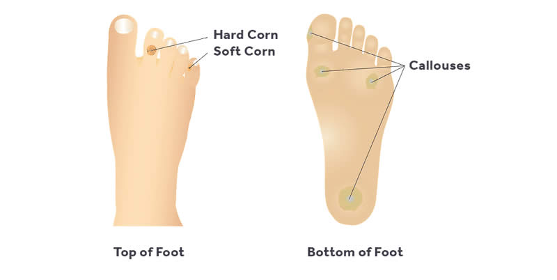 diagram showing different calluses and corns on feet
