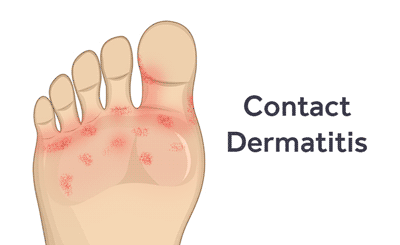 Learn to Prevent, Diagnose and Treat Contact Dermatitis illustration of contact dermatitis on feet