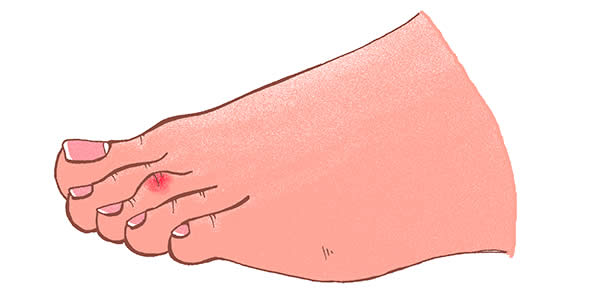 Drawing of Claw Toes