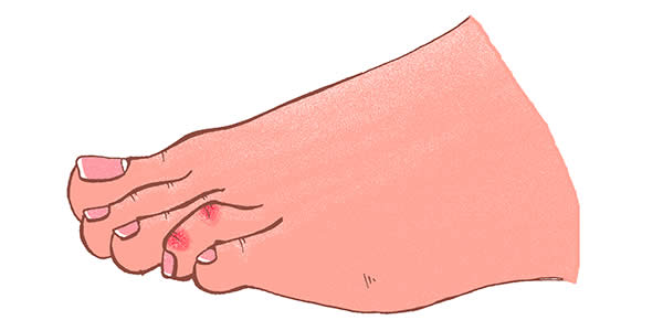 Drawing of Mallet Toes