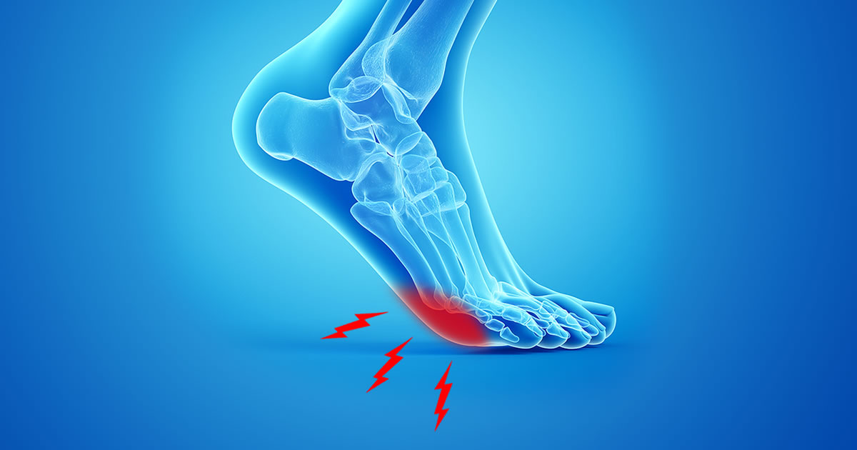 Why is My Foot Numb? Steps to Treat Neuromas Naturally