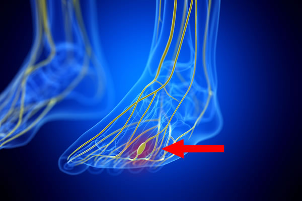 Neuroma Between Metatarsal Bones in Foot