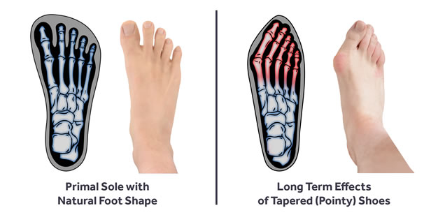 diagram showing a primal sole with natural rounded toe box versus a traditional shoe with pointy toe box causing long term forefoot deformation